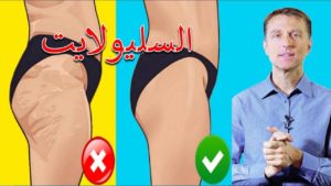 السيلوليت | أسباب لايذكرها الأطباء وعلاجه مع الدكتور بيرج – احتباس السوائل