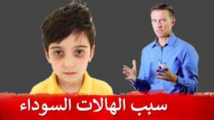 الهالات السوداء | سبب السواد تحت العين لدى الأطفال