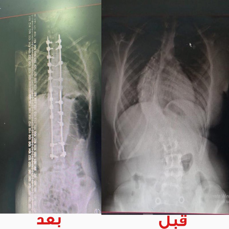 جراحة ناجحة لتصحيح انحراف عمود فقري بمستشفى الملك فهد بالمدينة