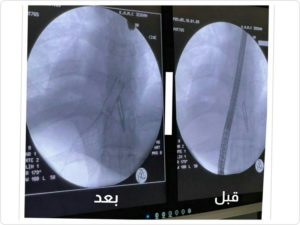 جدة.. دعامة حديدية تُنقذ شابًّا من ناسور المريء دون تدخل جراحي