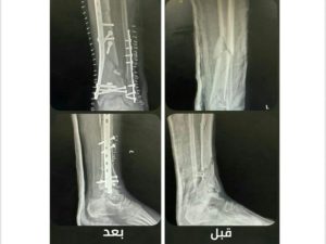 سقوط عامل من الطابق الثاني في جدة.. وتدخّل طبي ينقذه من الشلل