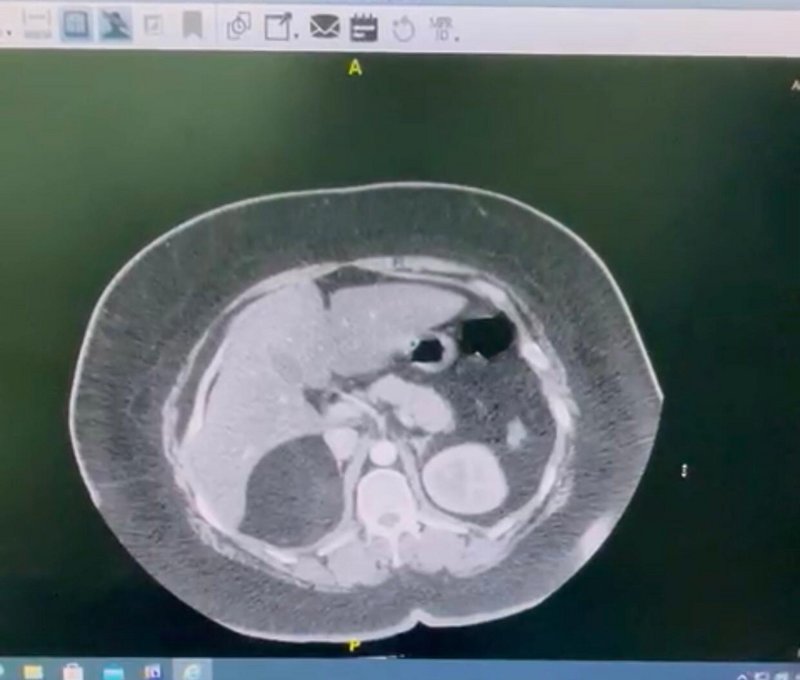 ألم مزمن بالبطن ينتهي باستئصال ورم في الغدة الكظرية لعشرينية بمكة