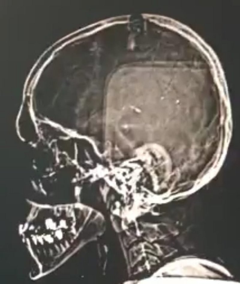 جراحة عاجلة بالرأس تنقذ عشرينيًا من شلل طرفي بمستشفى محايل