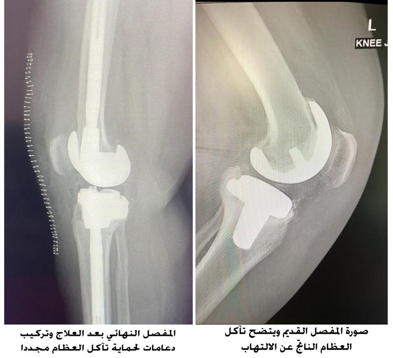 بجراحتين معقدتين.. مستشفى سليمان الحبيب يُنهي معاناة خمسينية من م