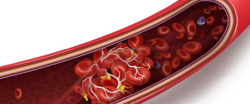هذه العلامات المُنبِّهة التي تُحذِّر من الجلطة الدموية.. تَعَرَّف