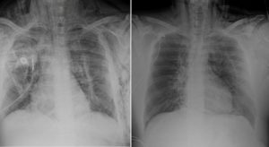 إنقاذ حياة “عشريني” في مستشفى سليمان الحبيب بالريان بتقنية “ECMO”