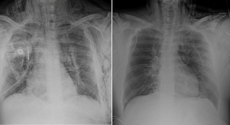 إنقاذ حياة “عشريني” في مستشفى سليمان الحبيب بالريان بتقنية “ECMO”