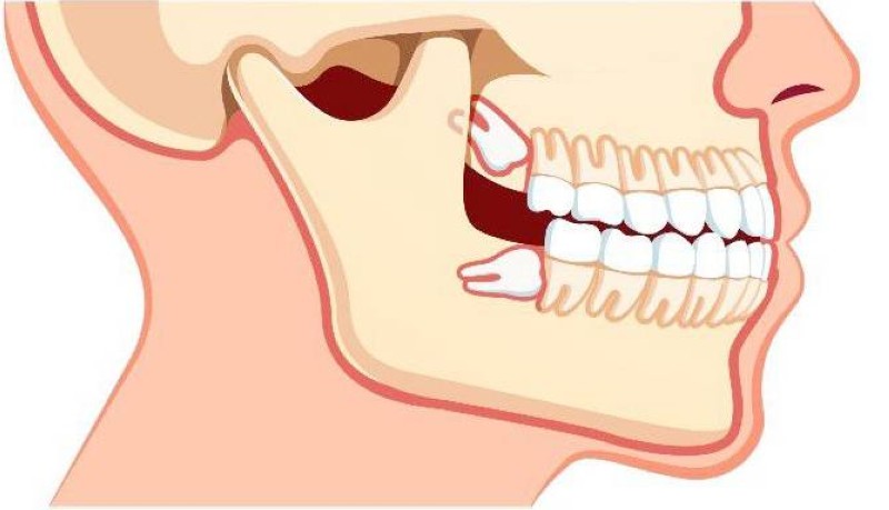 لماذا يتأخر نمو ضرس العقل؟ – أخبار السعودية