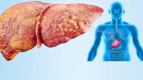 انتبه… هذا الألم قد يدل على الإصابة بمرض الكبد الدهني!