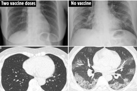 صور أشعات مقطعية على الرئة تكشف أهمية الحصول على لقاحات كورونا