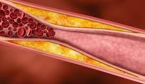 باحثون يتوصلون لاستراتيجية جديدة للوقاية من انسداد الشرايين