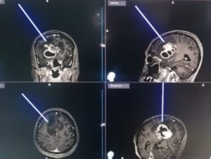 أول عملية جراحية لاستئصال ورم في الدماغ بمدينة الملك سلمان الطبية – أخبار السعودية