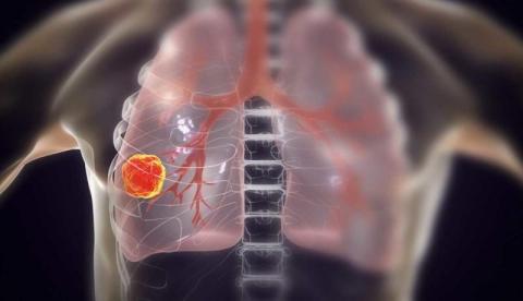 طبيب: سرطان الرئة هو الأكثر انتشارا في العالم