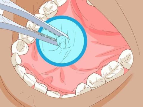 حصوات الغدد اللعابية… الأسباب والأعراض والعلاج