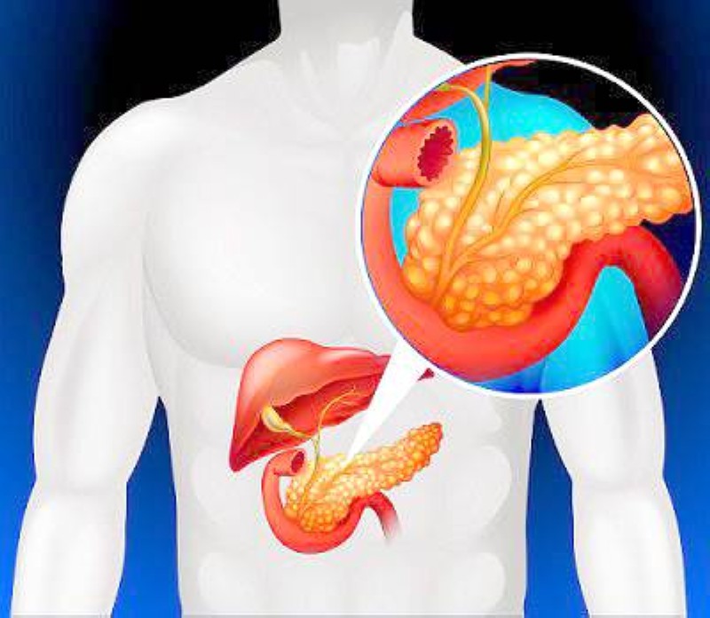 7 مؤشرات مبكرة وخطيرة لاكتشاف سرطان البنكرياس.. لا تتجاهلها – أخبار السعودية