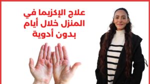 علاج الاكزيما خلال ايام بوصفة بسيطة جدا