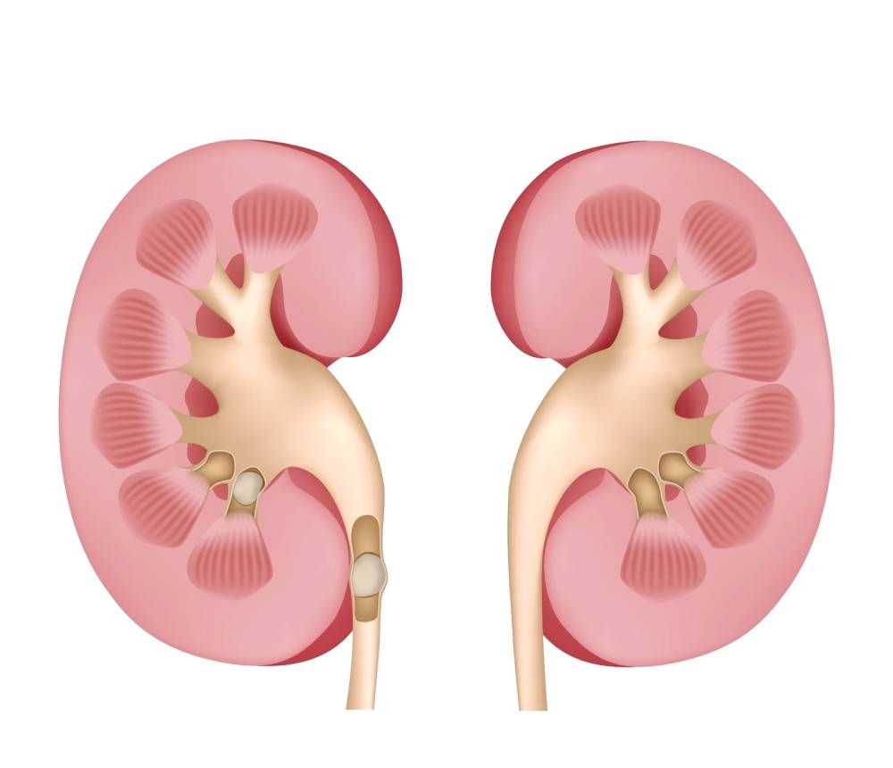 الإصابة بحصى الكلى تزداد خلال أشهر الصيف! – أخبار السعودية