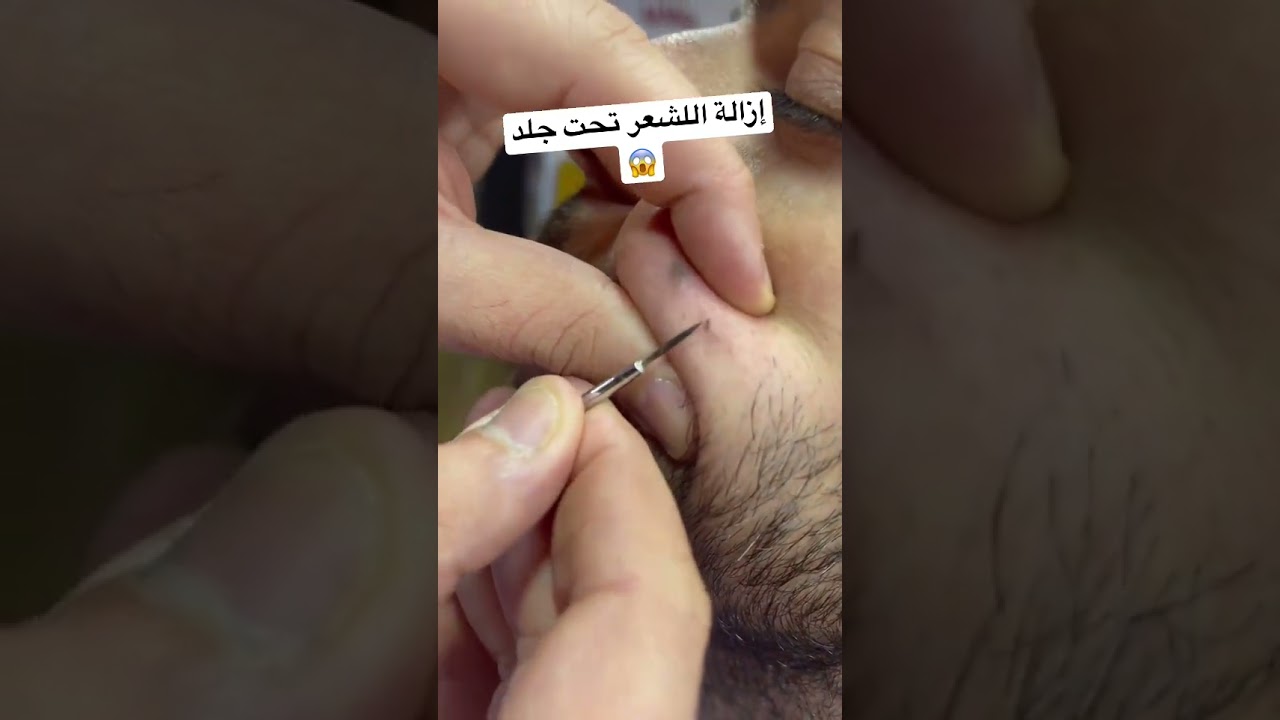 إزالة الشعر تحت الجلد Ziwan removal● ASMR BARBER #TUTORIAL #trending #2023 #tiktok  #shorts